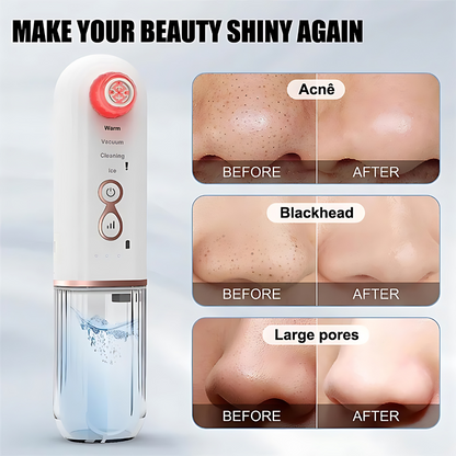 AquaBreeze Skincare BlackHead Remover Rejuvenation